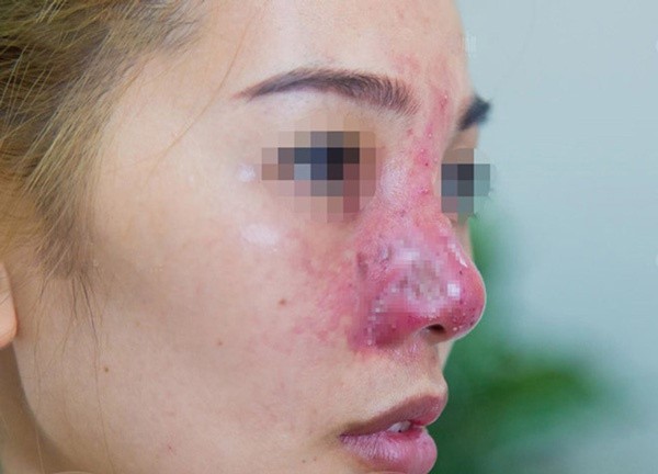 Có rất nhiều dấu hiệu nhận biết mũi bị hỏng cần phải sửa lại
