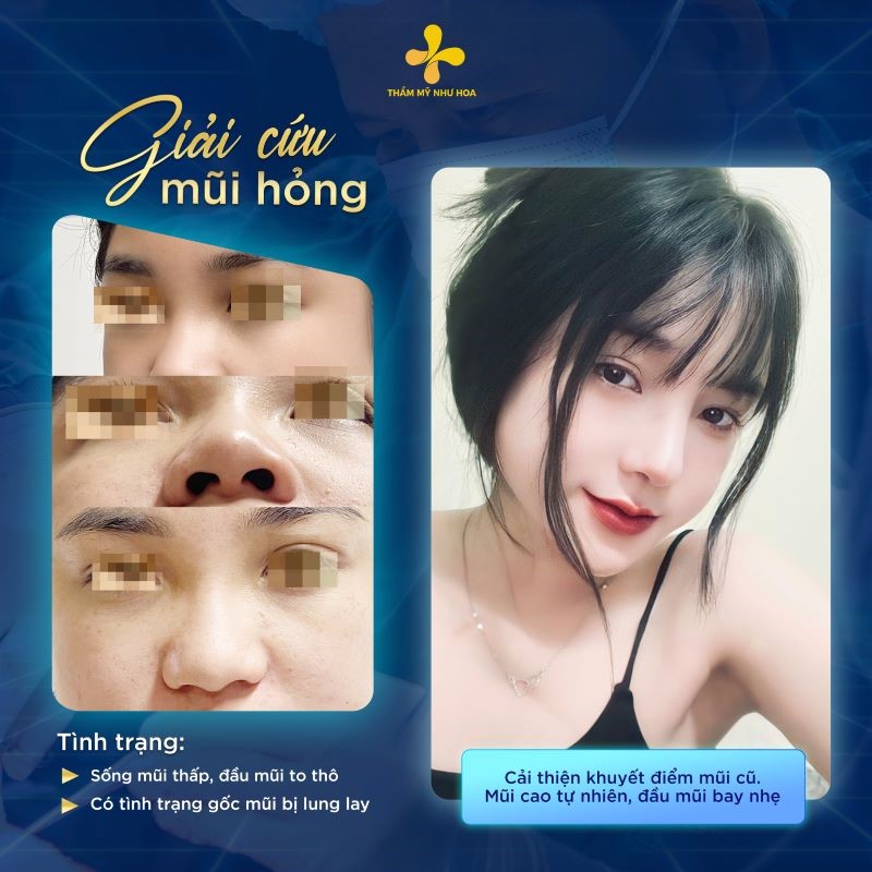 Kết quả giải cứu mũi hỏng tại Thẩm mỹ Như Hoa