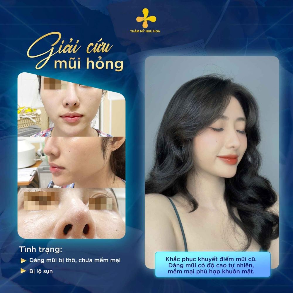 Khách hàng sửa mũi hỏng thành công tại Thẩm mỹ Như Hoa
