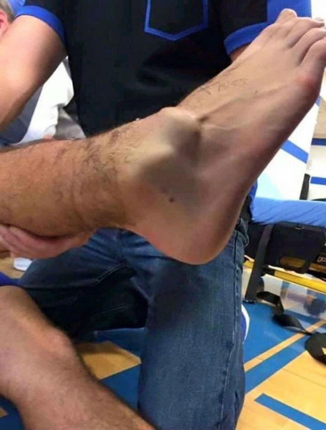 Chân của Gomes biến dạng