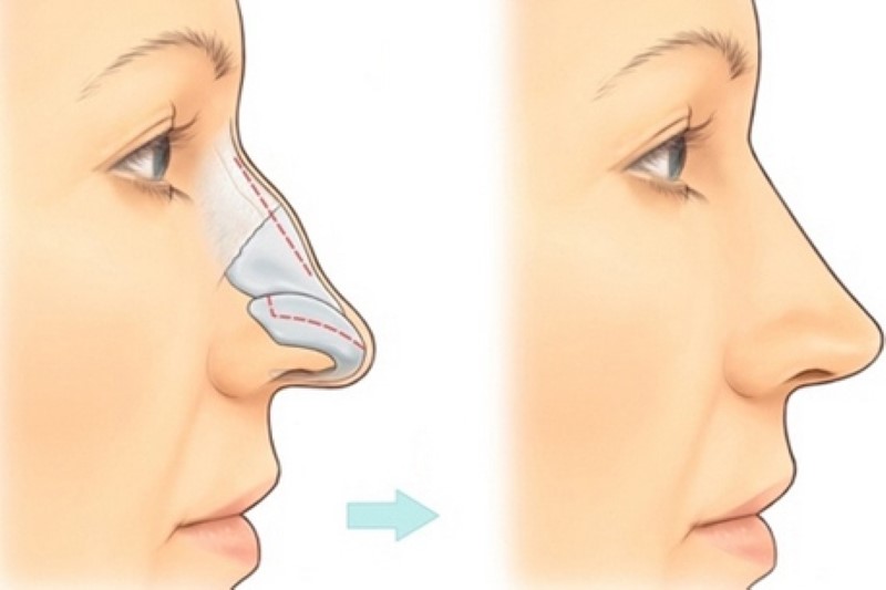 Nâng mũi có nguy hiểm và có hại về sau không?