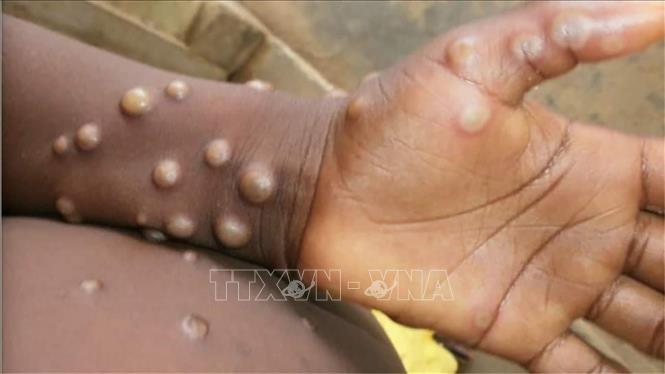 Các phần bị tổn thương xuất hiện trên tay và chân em nhỏ bị nghi mắc bệnh đậu mùa khỉ ở Bondua, Liberia. Ảnh: Getty Images/TTXVN