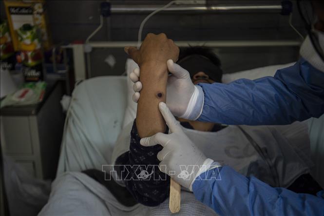 Nhân viên y tế điều trị cho bệnh nhân mắc đậu mùa khỉ tại bệnh viện ở Lima, Peru, ngày 16-8-2022. Ảnh tư liệu: AFP/TTXVN