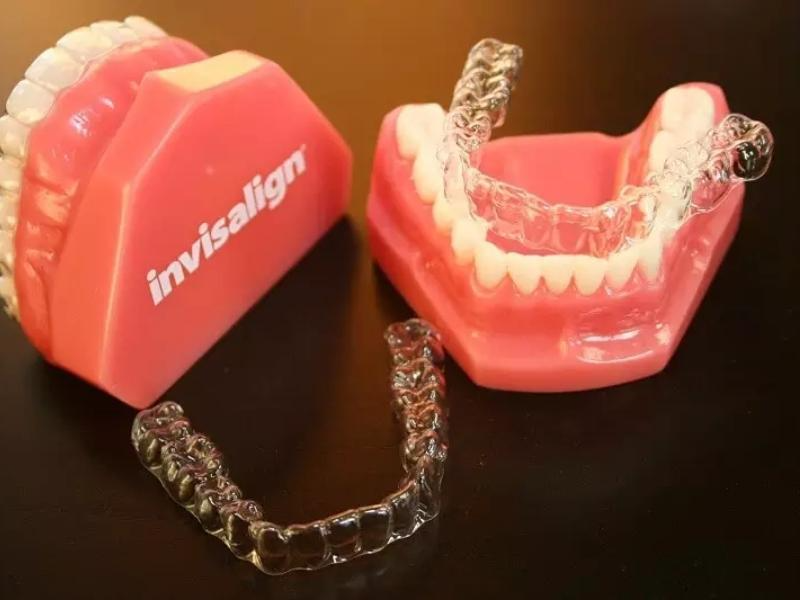 Những ưu điểm vượt trội của niềng răng trong suốt invisalign