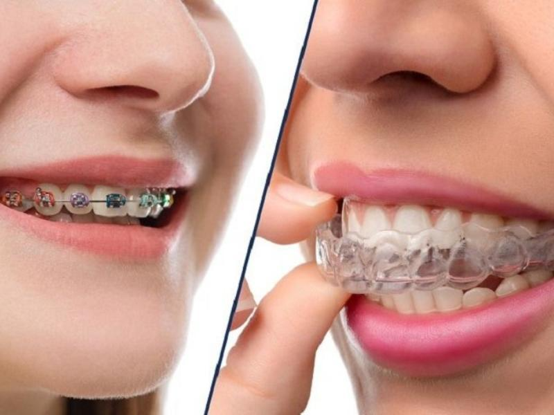 Những ưu điểm vượt trội của niềng răng trong suốt invisalign