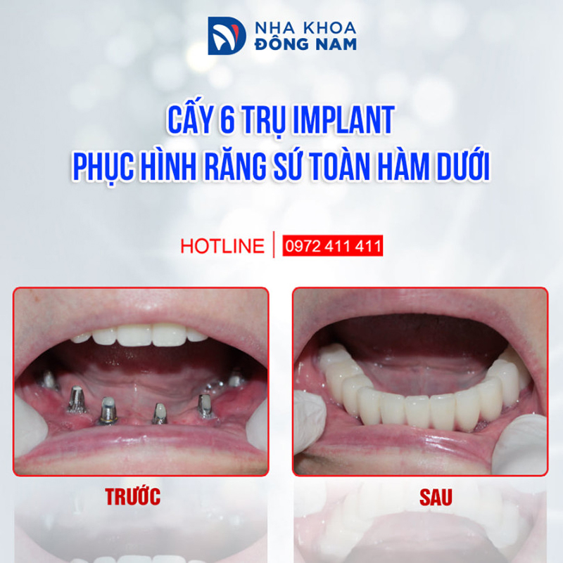 Nha khoa Đông Nam Nguyễn Kiệm có tốt không?