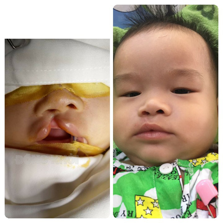 Bệnh nhi do Bác sĩ Công Út phẫu thuật chỉnh hình.