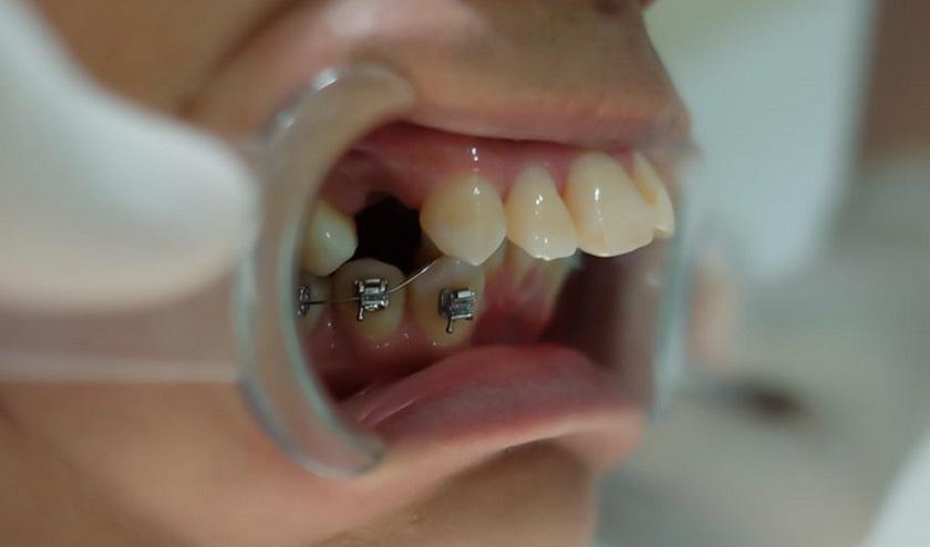 Một số khách hàng cần nhổ răng khi niềng.