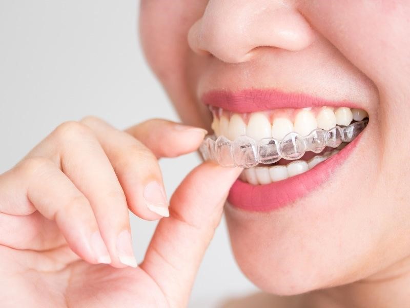 Niềng răng trong suốt là phương pháp chỉnh nha hiện đại sử dụng chất liệu niềng răng bằng nhựa trong