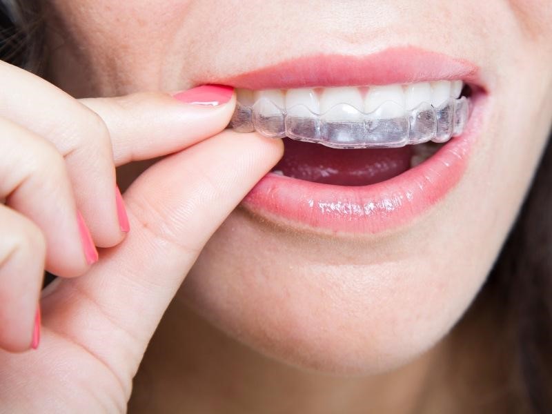 Niềng răng trong suốt được nhiều người yêu thích nhờ vào việc tháo, lắp dễ dàng