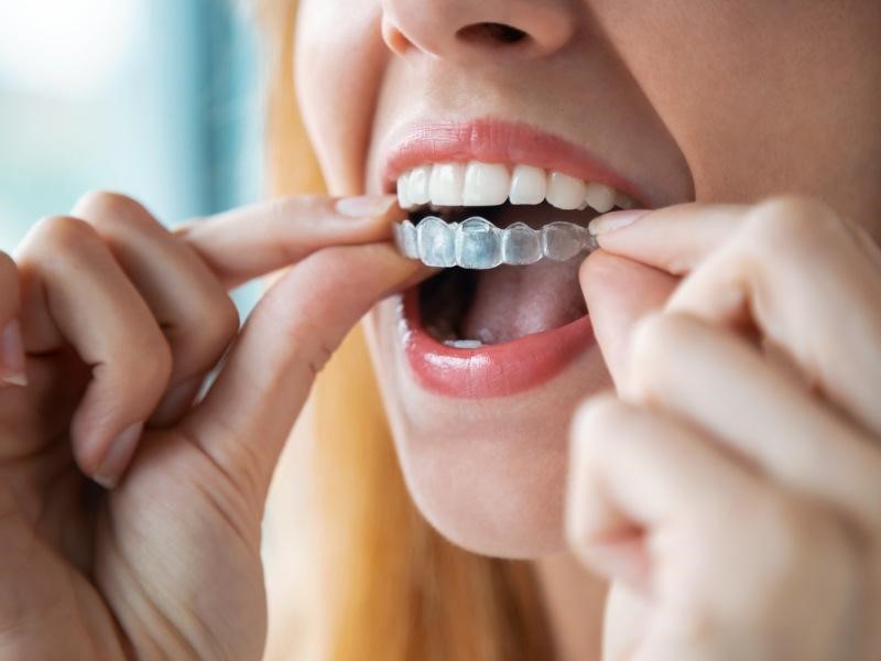 Độ tuổi người thực hiện ảnh hưởng đến giá niềng răng trong suốt