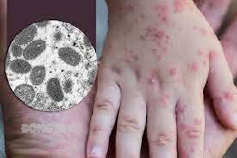 Tăng cường thực hiện các biện pháp phòng, chống bệnh đậu mùa khỉ Tăng cường thực hiện các biện pháp phòng, chống bệnh đậu mùa khỉ. Ảnh: Sưu tầm.