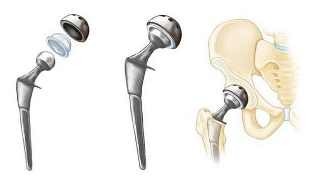 Chi phí thay khớp háng có bảo hiểm tại bệnh viện ĐKQT Nam Sài Gòn: Tin vui cho người bệnh Thay khớp háng không bảo hiểm y tế có chi phí rất cao