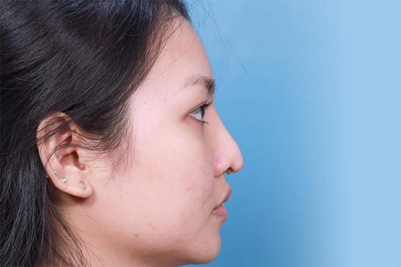Có nên nâng mũi không? 4 Điều cấm kỵ cần biết khi nâng mũi Lạm dụng sụn tai để nâng cao sống mũi dễ gặp biến chứng co rút, biến dạng mũi