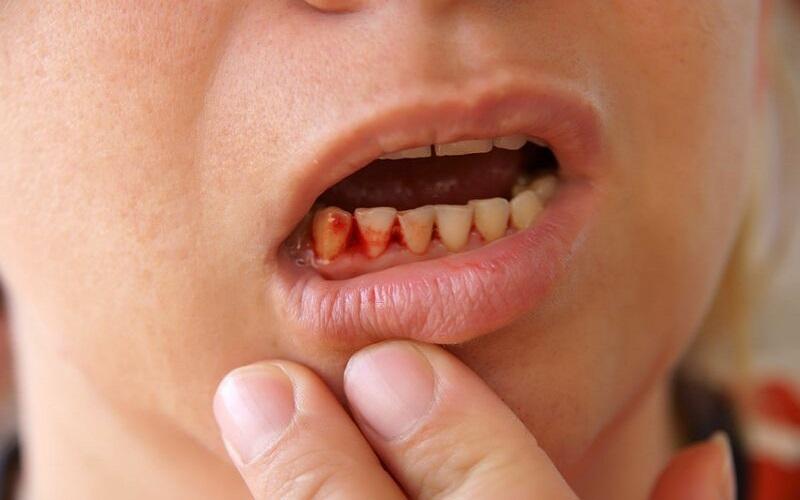 Cảnh báo những biến chứng khi cấy ghép Implant