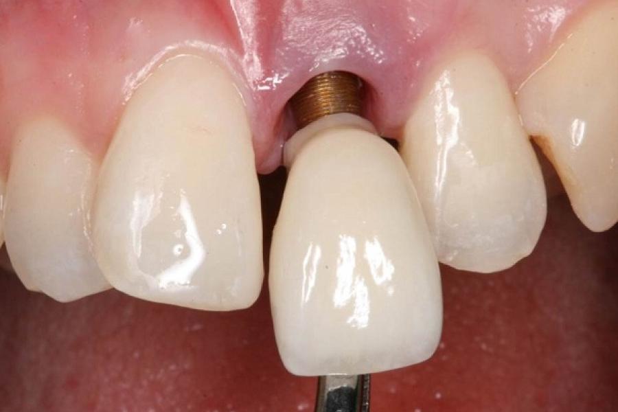 Cảnh báo những biến chứng khi cấy ghép Implant