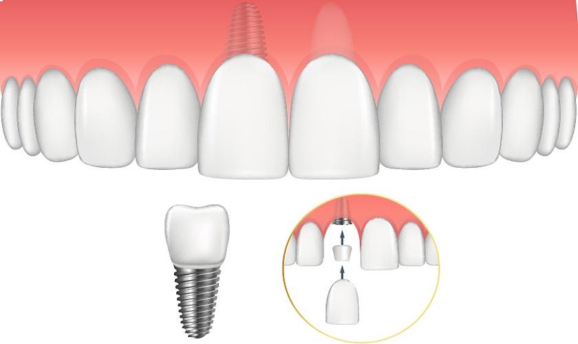 Trồng răng implant có đau không? Các loại trụ răng implant hiện nay