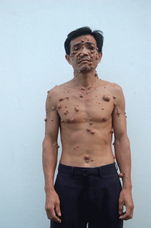 Người mang nhiều khối u trên thân thể
