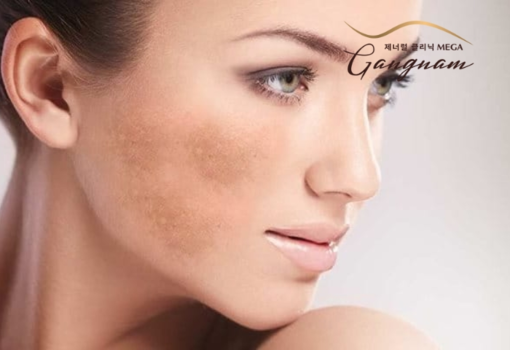 Mega Gangnam - Thẩm mỹ viện uy tín cho việc điều trị nám mảng Mega Gangnam - Thẩm mỹ viện uy tín cho việc điều trị nám mảng