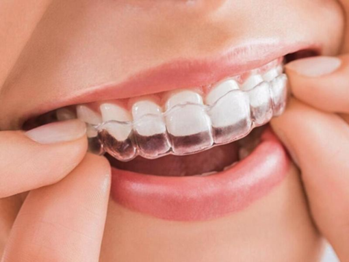 Những ưu điểm vượt trội của niềng răng trong suốt invisalign