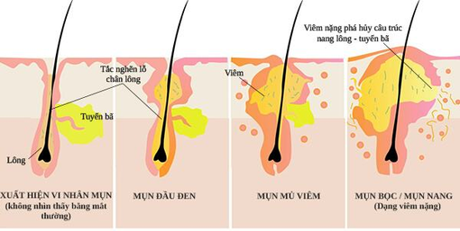Lưu ý khi trị mụn tận gốc spa thẩm mỹ an toàn, hiệu quả Lưu ý khi trị mụn tận gốc spa thẩm mỹ an toàn, hiệu quả