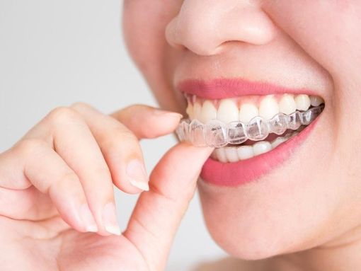 Niềng răng trong suốt giá rẻ có tốt không? Niềng ở đâu uy tín? Niềng răng trong suốt giá rẻ có tốt không? Niềng ở đâu uy tín?