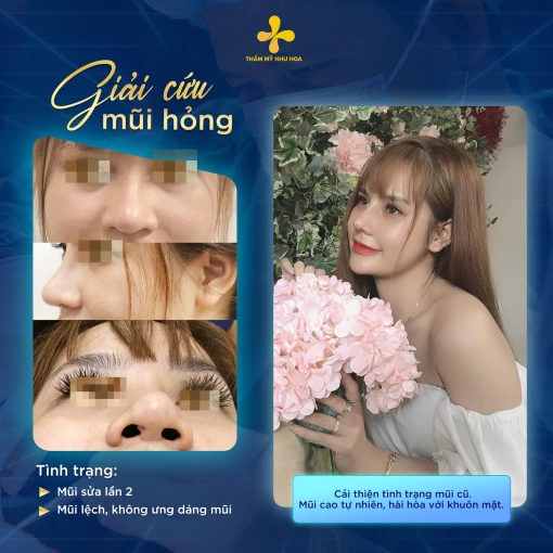 Sửa mũi lại có đau không? Chia sẻ những kinh nghiệm bạn không nên bỏ lỡ