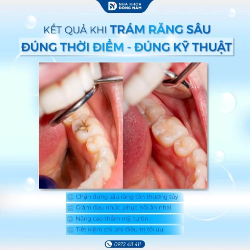Trám răng sâu giúp phòng ngừa bệnh răng miệng nghiêm trọng