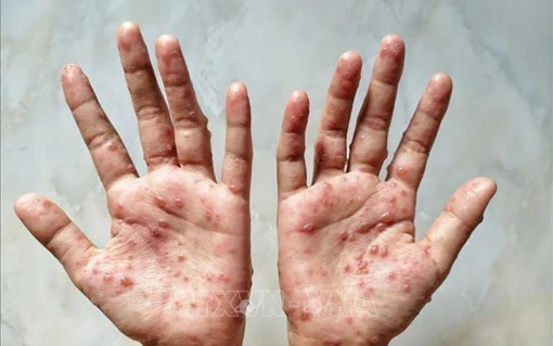 Chủ động phòng, chống dịch bệnh đậu mùa khỉ