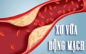 8 cách giúp phòng xơ vữa động mạch, ngăn ngừa đột quỵ