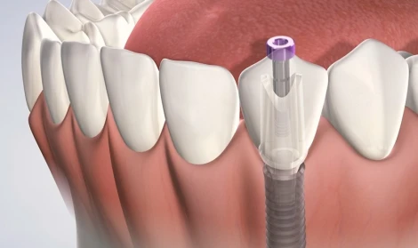 Implant là gì và giá trồng răng implant khoảng bao nhiêu?