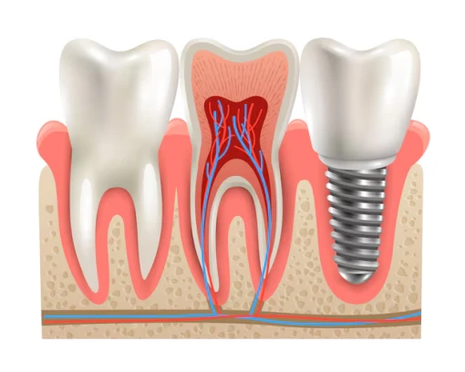 5 thông tin có thể bạn chưa biết về trồng răng Implant