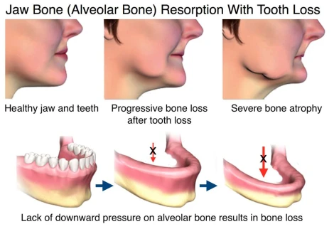 Những điểm quan trọng cần lưu ý trước khi trồng răng Implant