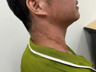 Ghi nhận bệnh nhân thứ 26 mắc giun rồng tại Việt Nam